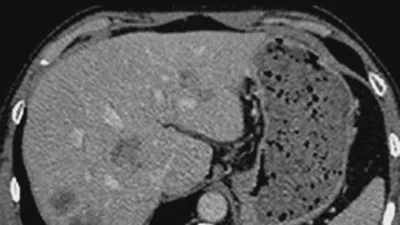 The Liver Tumor Segmentation Benchmark (LiTS) featured image