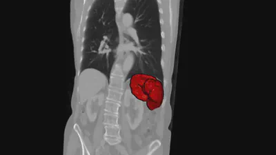 Fully Automatic Volume Measurement of the Spleen at CT Using Deep Learning featured image
